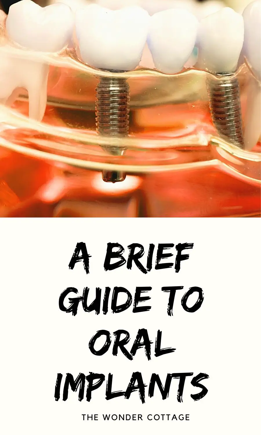 A Brief Guide To Oral Implants