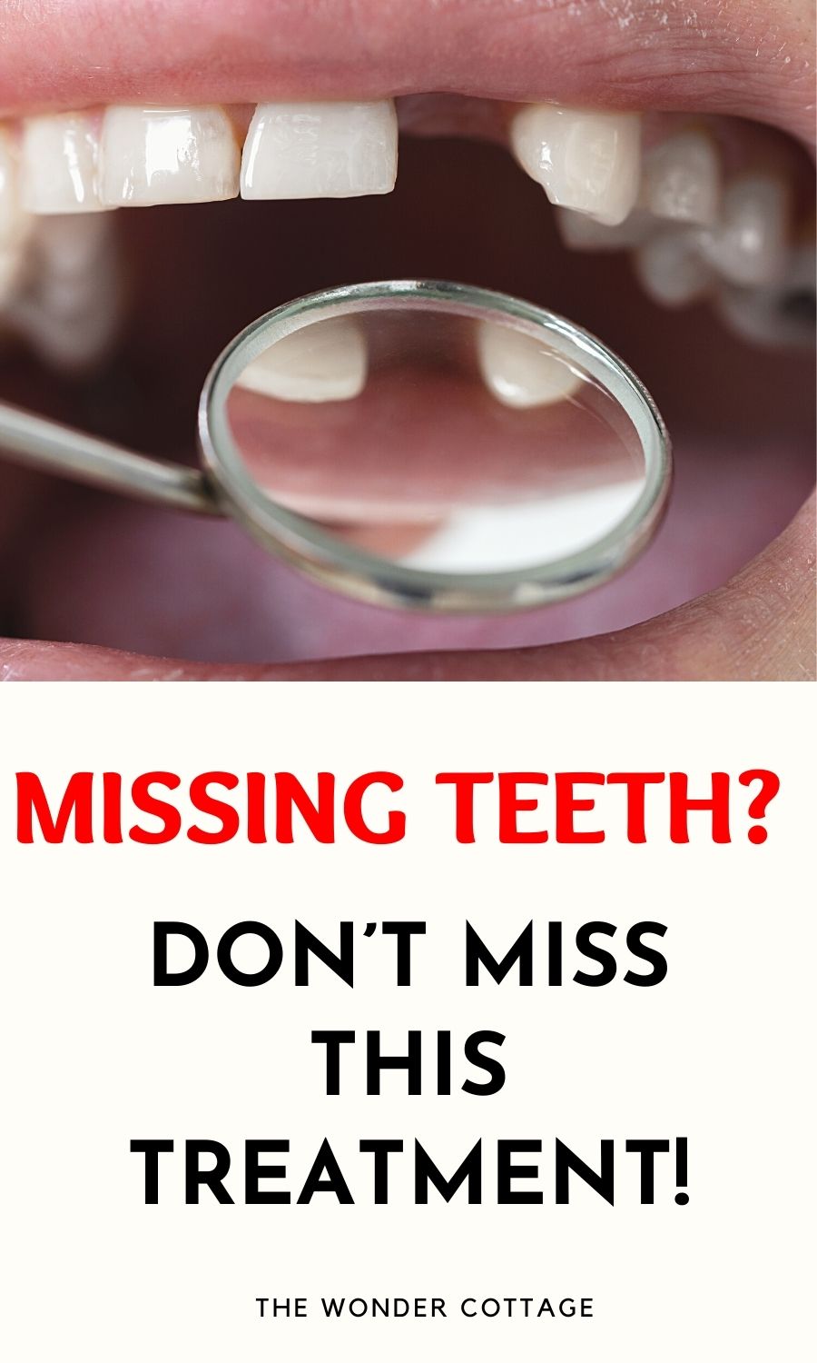 Missing Teeth? Don’t Miss This Treatment!