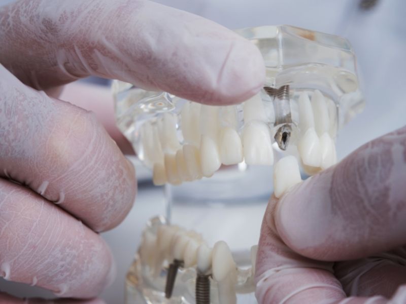 orthodontist showing how dental implants work